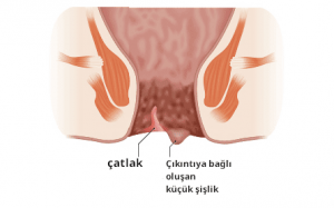 Anal fissür çatlak